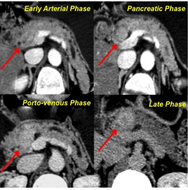 Fig.  4-  Pattern  B2.  The  lesion  of  the  pancreatic  head  appears  as  isodense  in  respect  to  the  parenchyma  in  the  early  arterial  and  pancreatic phases