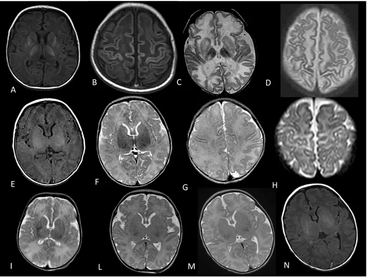Fig  2:  A–B, T1-weighted axial spin echo images showing severe bilateral abnormally increased SI in the lentiform  nuclei and thalami, with absent of normal SI in the posterior limb of the internal capsule and cortical highlighting
