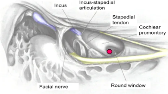 Figure 17: Facial recess approach to the middle ear. 