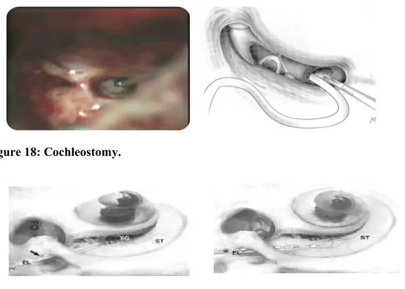 Figure 19:  A more superior cochleostomy placement would result in injury to the spiral  ligament or the basilar membrane, or even result in direct entry to the scala vestibuli