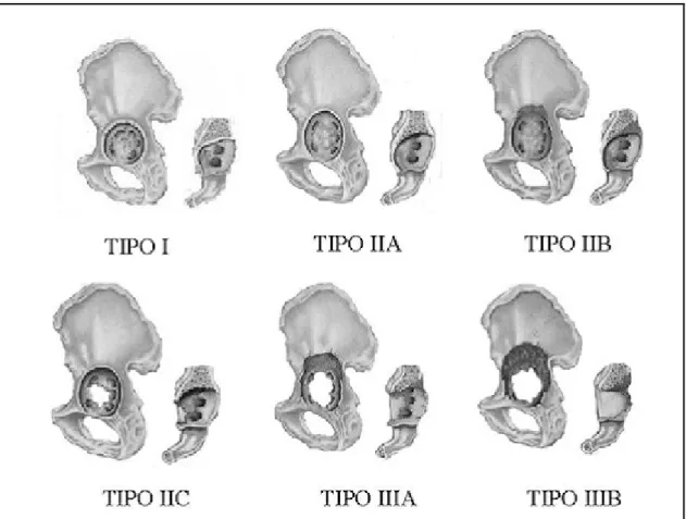 Tabella n.4: Classificazione dei difetti ossei acetabolari di Paprosky [13].