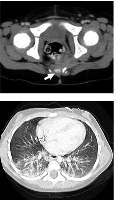Figura 4. TC  addome-pelvi: yolk  sac tumor in  bambina di 2 anni  Figura 5. TC  torace: metastasi  polmonari da yolk  sac tumor 