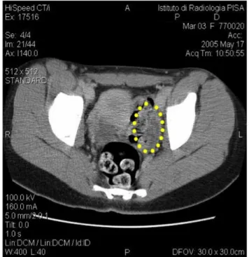 Figura 6. TC addome- addome-pelvi: massa ovarica  sinistra di tipo solido  (cisti emorragica del  corpo luteo) in  paziente di 14 anni 