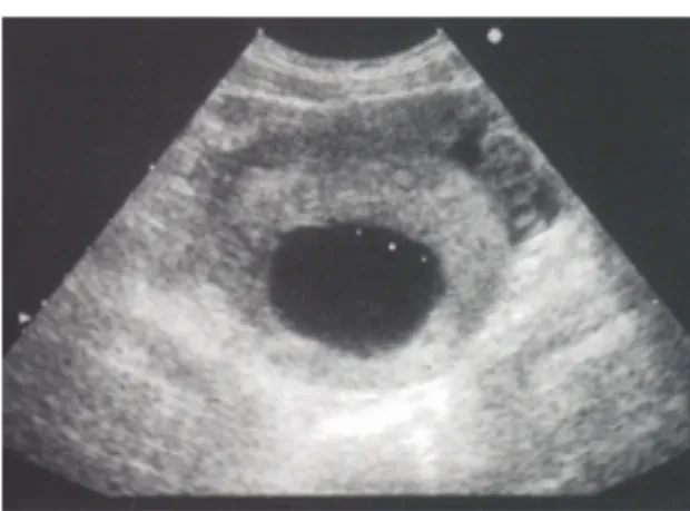 Figura 7. Immagine  US della torsione di  una cisti emorragica  del corpo luteo  dell'ovaio destro, in  ragazza di 13 anni 