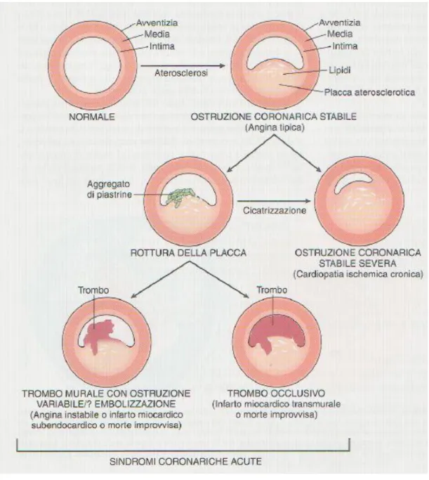 Figura 2 – I possibili esiti della rottura di placca “vulnerabile” (da Robbins e Cotran, “le basi patologiche  delle malattie” 7ma ed., 2006.)  
