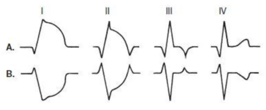 Figura 6 - Rappresentazione schematica dell’evoluzione elettrocardiografica in 4 stadi dell’infarto miocar- miocar-dico