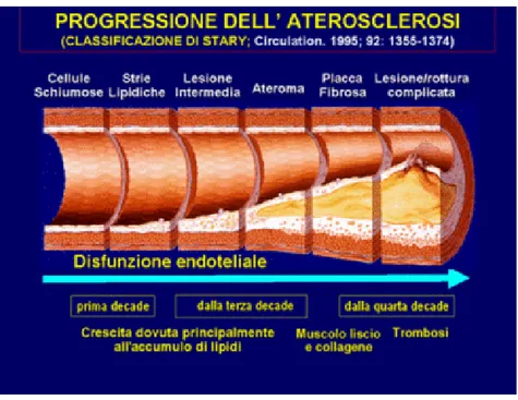 Figura 1 – La progressione della patologia aterosclerotica (classificazione di Stary, Circulation, 1995.)