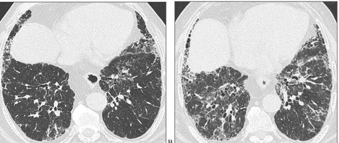 Figure 4. HRCT images of a patient belonging to UIP group at the baseline (A) and after 1 year of follow-up (B)