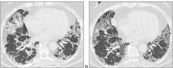 Figure 11. HRCT images of a patient belonging to possible-UIP group at the baseline (A) and after 3 years of follow-up  (B)