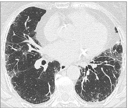 Figure 2. HRCT images demonstrating possible-UIP pattern in a patient classified into group 2 with a moderate amount  of ground-glass plus reticulation without honeycombing