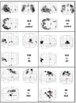 Figure  3  MIP  (maximum  intensity  projection)  images  reporting  brain  areas  with  significant  reduction  of  rCBF  (p&lt;0.001)  (top)  in  parieto-occipital  and  frontal  areas in DLB and PDD with  respect to controls, (middle)  in  occipital  re