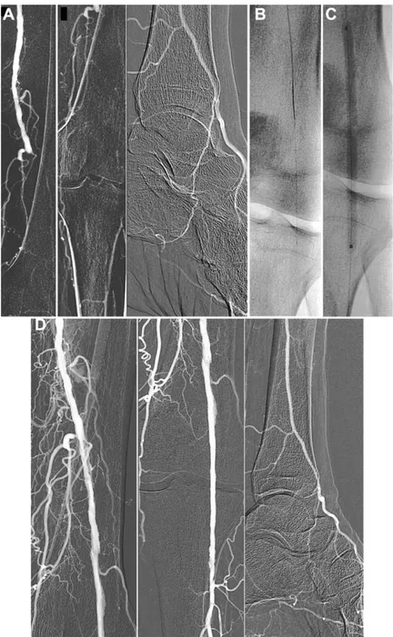 Figure 3 ¤ (A) An intraprocedural diagnostic angiogram evidenced a total occlusion at the distal third of the SFA and of the popliteal artery with reconstitution at the origin of the bifurcation between the posterior tibial artery and the peroneal artery, 