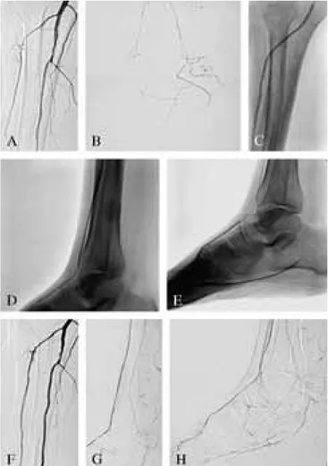 Figure 1.—PTA with the Amphirion™ Deep 210-mm tapered balloon in a patient with critical limb ischemia (Rutherford class 5) and diffuse occlusive disease of the anterior and posterior tibial arteries (A, B)