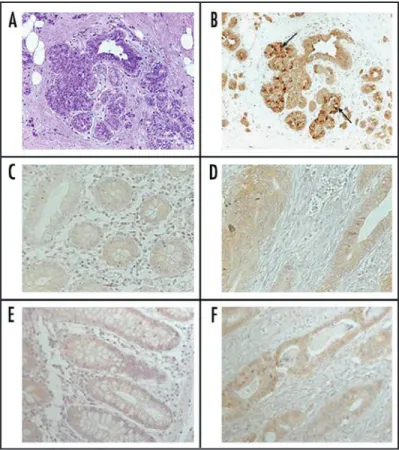 Figure  1.  Immunohistochemical  FAS  protein  expression  in  representative  human breast (A and B) and colon (C–F) cancer cases