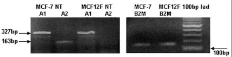 Figure  6.  CPT1A  transcript  variants  expression  in  normal  and  cancerous  breast  epithelial  cells