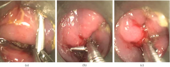 Figure 5 shows the intraluminal, Figure 6 shows the extraluminal aspect of the clipping site after the closure of a gastrotomy in the domestic pig.