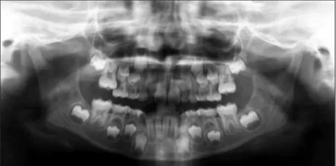 Figure 2. Panoramic radiograph showing bilateral ectopic  eruption of the permanent maxillary first molars in an  8-year-old subject