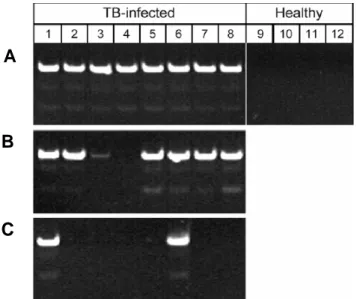 Figure 3: Semi-nested PCR for M. tuberculosis in whole urine (A) compared with  products from DNA extracted from matched supernatant (B) and sediment (C) following  centrifugation at 4000xg, 20 min at ambient temperature