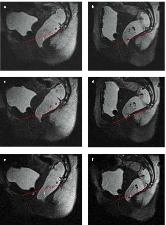 Fig. 4a-f Rectal prolapse. Images ob- ob-tained in the orthostatic position at rest  (a), during contraction (c) and straining  (e) and during the same phases in the  supine position (b,d,f)