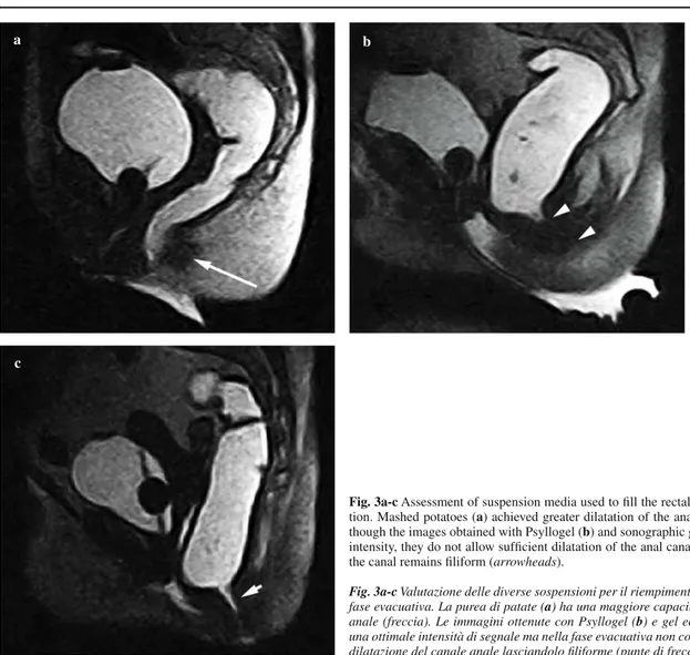 Fig. 3a-c Assessment of suspension media used to fi ll the rectal ampulla during defeca- defeca-tion