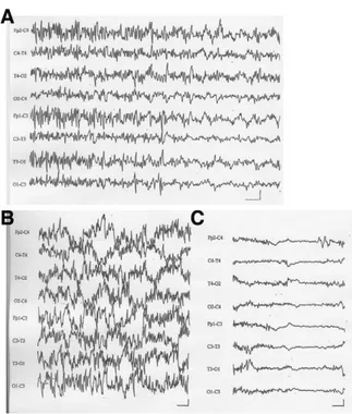 Figure 1 ⽧ (A) In this patient with left carotid artery stenosis, carotid clamping induced an increase in amplitude of slow waves (1-Hz frequency) and  si-multaneous reduction in faster frequencies  local-ized in the left front, central, and temporal regio