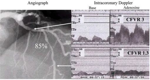 Fig. 1 The importance of measuring CFVR distal to the stenosis. Before the stenosis CFVR measured by intracoronary Doppler ultrasound is normal (upper panels) whereas distal to the stenosis it is significantly reduced (lower panels).