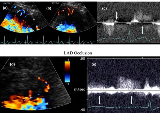 Fig. 4 Transthoracic coronary Doppler ultrasound is a unique technique to image perforators