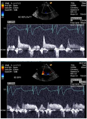 Fig. 8 Pulsed-Doppler ultrasound of the left anterior descending coronary artery in a patient treated early after coronary surgery with 2:1 aortic counterpulsation shows a 25% increase in coronary flow velocity in the assisted (Y) compared to the non-assis