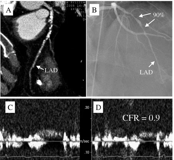 Figure 1. Typical patient with inconclusive multidetector computed tomographic findings (A) because of large amount of calcium in proximal and middle tract of LAD coronary artery