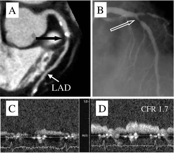 Figure 5. Linear correlation (and 99% confidence intervals) between quan- quan-titative coronary angiography (QCA) as obtained by invasive angiography (x axis) and multidetector computed tomography (CT angiography, y axis) in detecting LAD coronary artery 