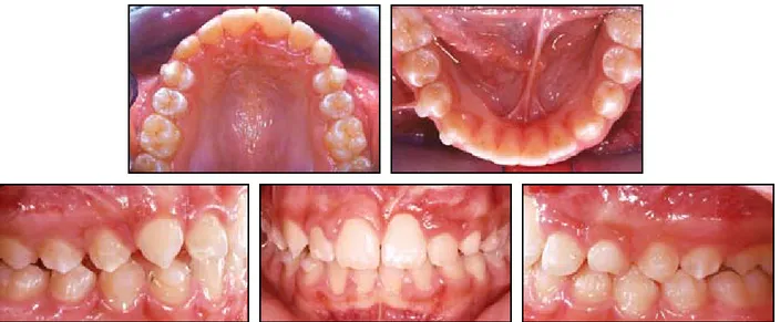 Fig. 8  Patient after five months of Invisalign Teen therapy.