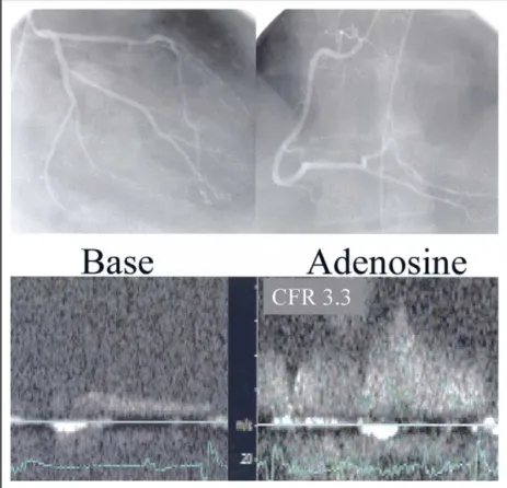 FIGURE 2. (Top) Angiographically normal coronary arteries in a patient in group 1.