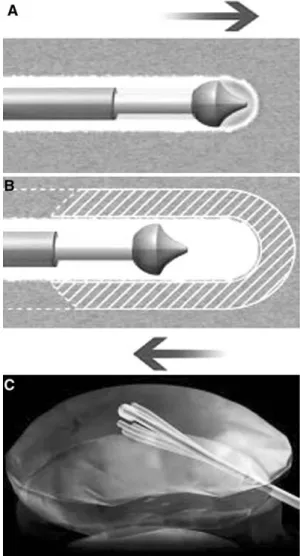 Fig. 3. A Anteroposterior and B lateral fluoroscopic ima- ima-ges: positioning of the tip of the spinal wand in the nucleus pulposus.