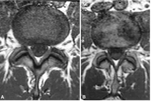 Fig. 5. MR images A before and B after treatment, showing clearly the reduction in the diskal lesion at 1 year follow-up.