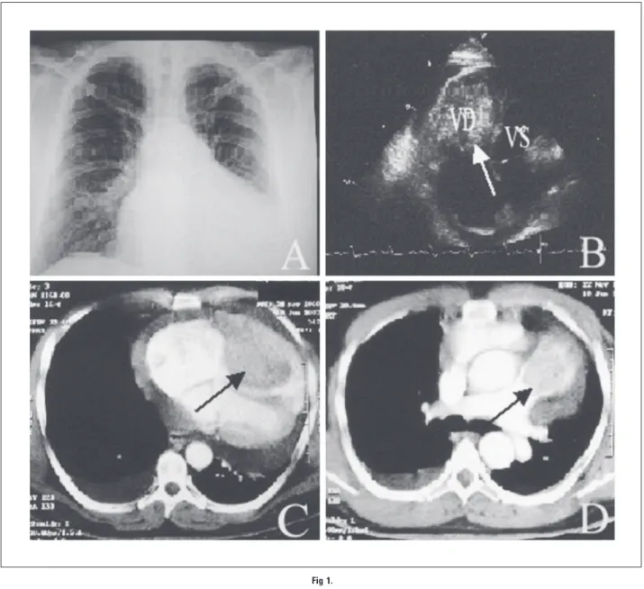 Fig 1C) protruding into the pulmonary conus (arrow, Fig 1D), pericardiac effusion, bilateral subpleural metastases, and a liver