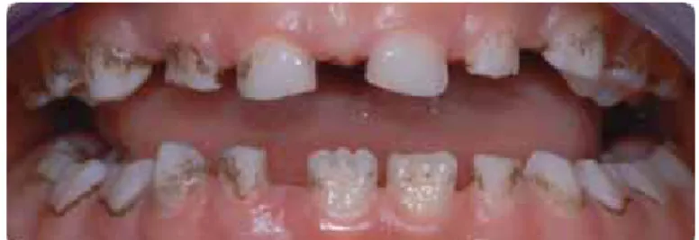 Fig. 1: aspetto clinico delle black stain: macchie brunastre o linee che si estendono sulla superficie del dente in modo continuo o discontinuo,
