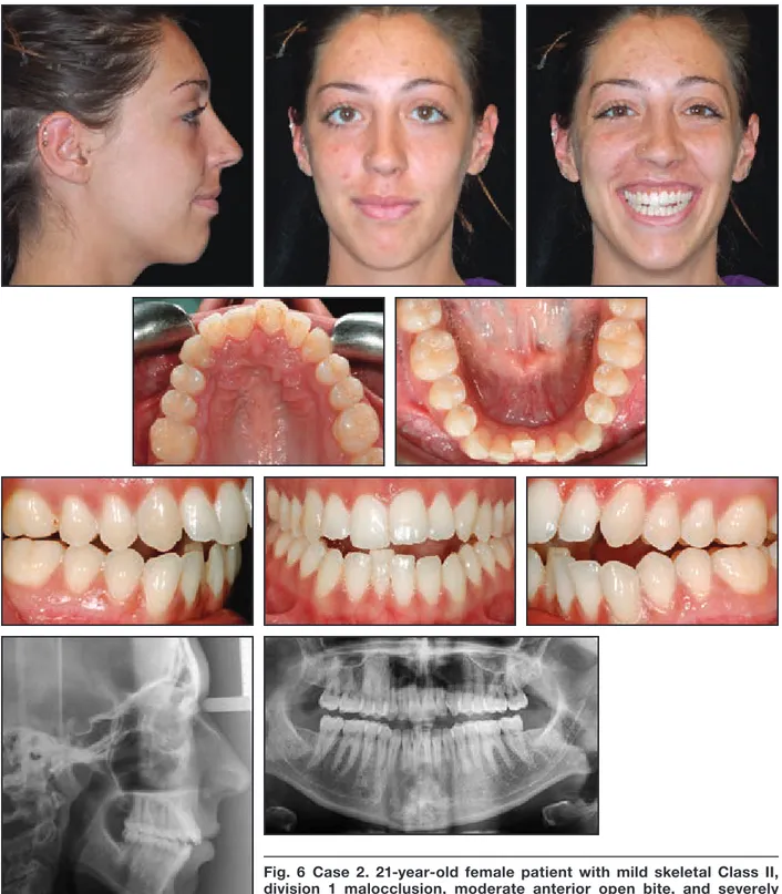 Fig. 6 Case 2. 21-year-old female patient with mild skeletal Class II,  division 1 malocclusion, moderate anterior open bite, and severely  hyperdivergent skeletal pattern before treatment.