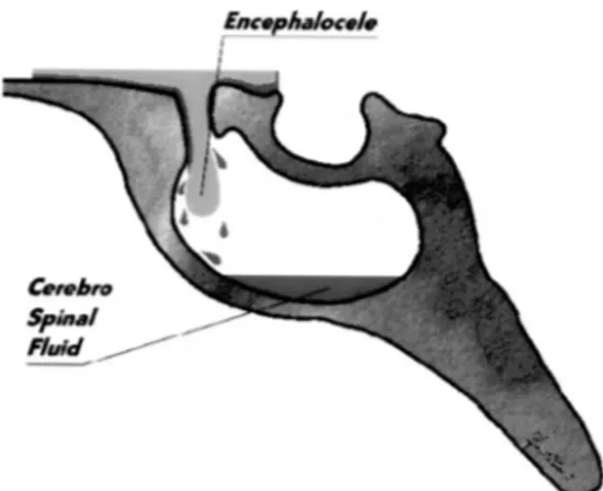 FIGURE 4. Drawing of the sphenoid sinus (sagittal view), showing the bone defect of the sphenoethmoidal planum and encephalocele associated with a CSF fistula.