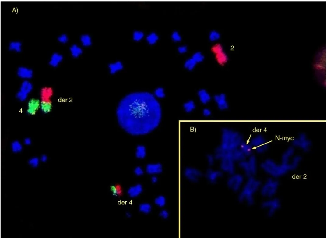Fig. 1. Panel (A) shows the results of fluorescence in situ hybridization (FISH) with Cy3-labelled (red) chromosome 2 and fluorescein-labelled (green) chromosome 4 libraries (dual-color painting), confirming the cytogenetic evidence of t (2;4) (p24;q12)