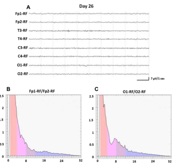 Fig. 3. Day 26 (A) EEG performed on the alert patient showing a regular, reactive and symmetric alpha background activity, intermixed by some theta and beta waves more evident on the bilateral frontal–central–temporal regions