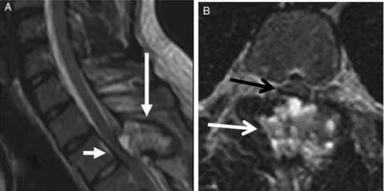 Figure 1 (A) Preoperative sagittal T2 weighted MR image of cervical and dorsal spine showing a tumoral mass (long white arrow) causing medullary compression at D2 level (short white arrow)
