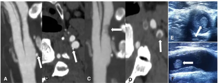 Fig. 1    CT angiography showing plaque ulceration (white arrow) of  left internal carotid artery in longitudinal and axial views soon after  patient admission (a,  b) and plaque thrombosis (white arrow) 6  h 