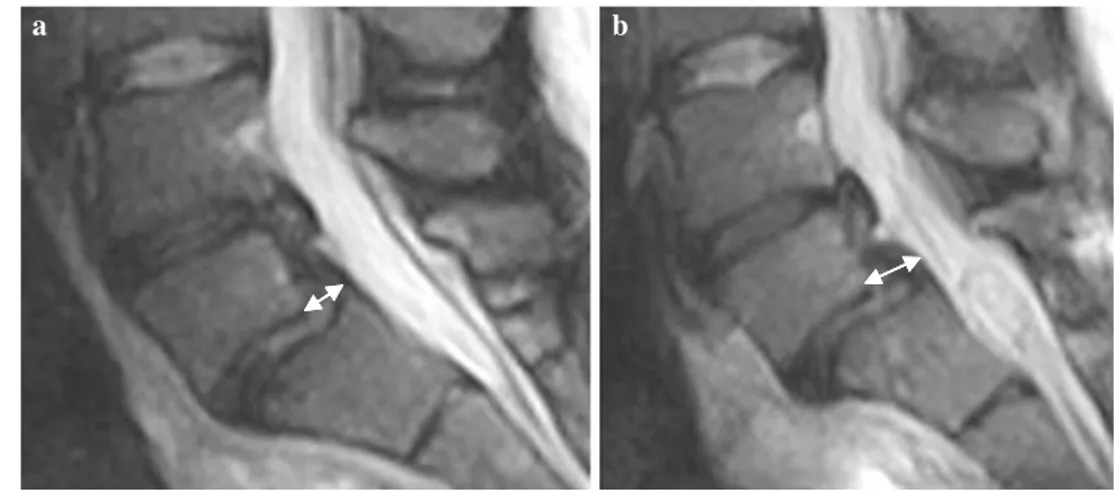 Fig. 10 Fast spin echo (FSE) T2-weighted magnetic resonance images (MRI) in the sagittal plane