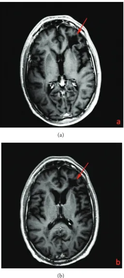 Figure 3: DWI ADC map (Philips Achieva 3T, TR = 4500 ms; TE = 112 ms) in December 2011 (a) and May 2012 (b) of the white matter lesion underneath the frontal lobe of the left hemisphere (arrows) with some diffusion restriction in a 44-year-old man with a 1