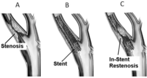 Fig. 3. Stenosis, stenting procedures and in-stent restenosis of a biological duct.