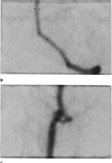 Figure  2.  (A)  Angiography  in  an  animal  I  day  after  SAH.  (B)  Magnified  view of the intracranial  vertebral and basilar artery (reproduced 