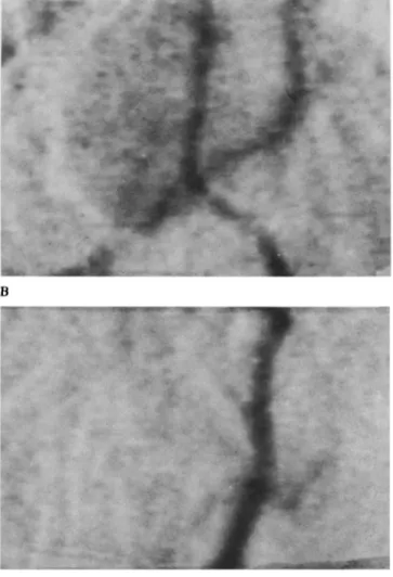 Figure 4.  (A) Angiography in  an animal 8  days following SAH. (B)  Magnified view of the intracranial vertebral and basilar artery (reproduced 