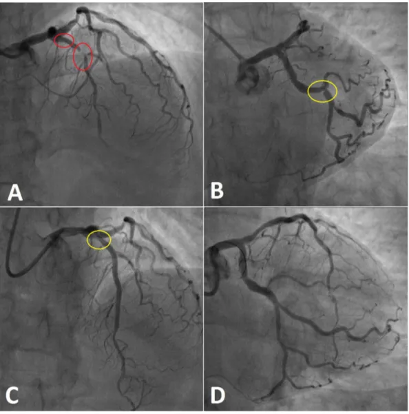 Fig. 1. Coronary angiograms. Diagnostic angiogram of the LAD (A) and Cx (B). (C) Final angiogram after deployment of 2 overlapped drug eluting stent in the proximal-mid LAD