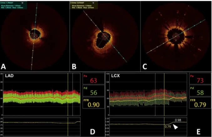 Fig. 2. Intracoronary imaging of the LAD (A–C) and functional assessment of both LAD and Cx arteries (D–E)