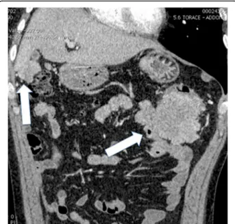 Fig. 2 Axial two-dimensional image obtained after intravenous administration of iodinated contrast agent, showing outcomes of right pneumonectomy ( arrow)